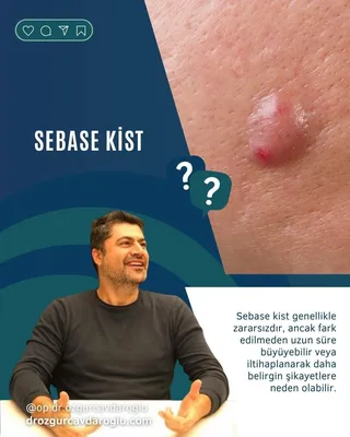 Sebase kist nedir