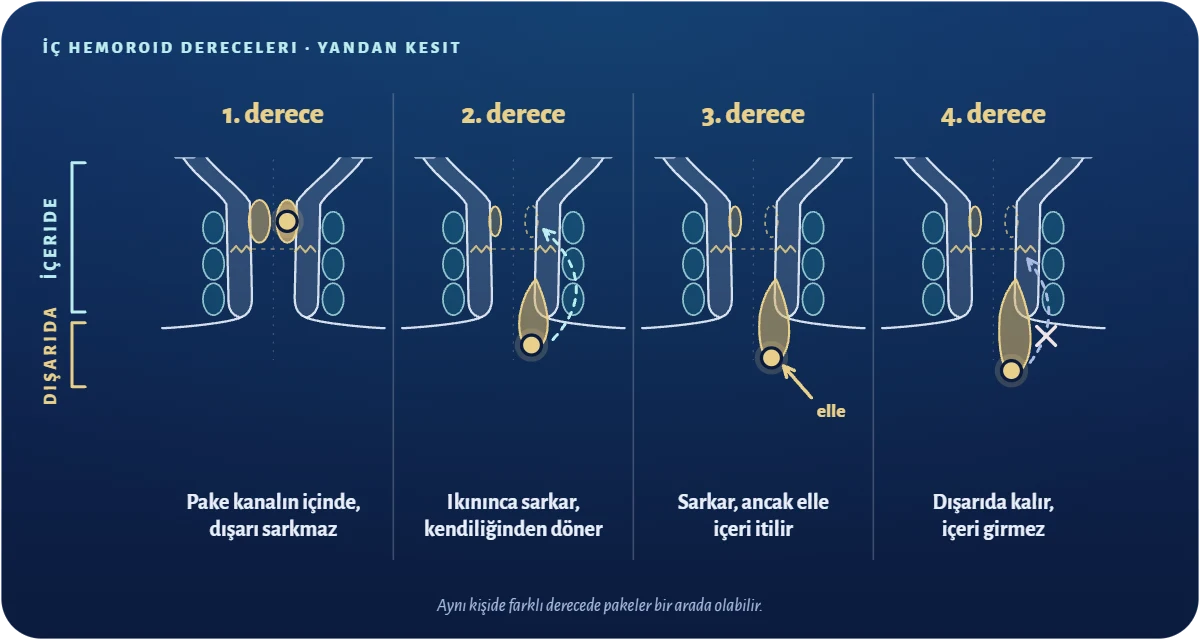 Hemoroid dereceleri resimli