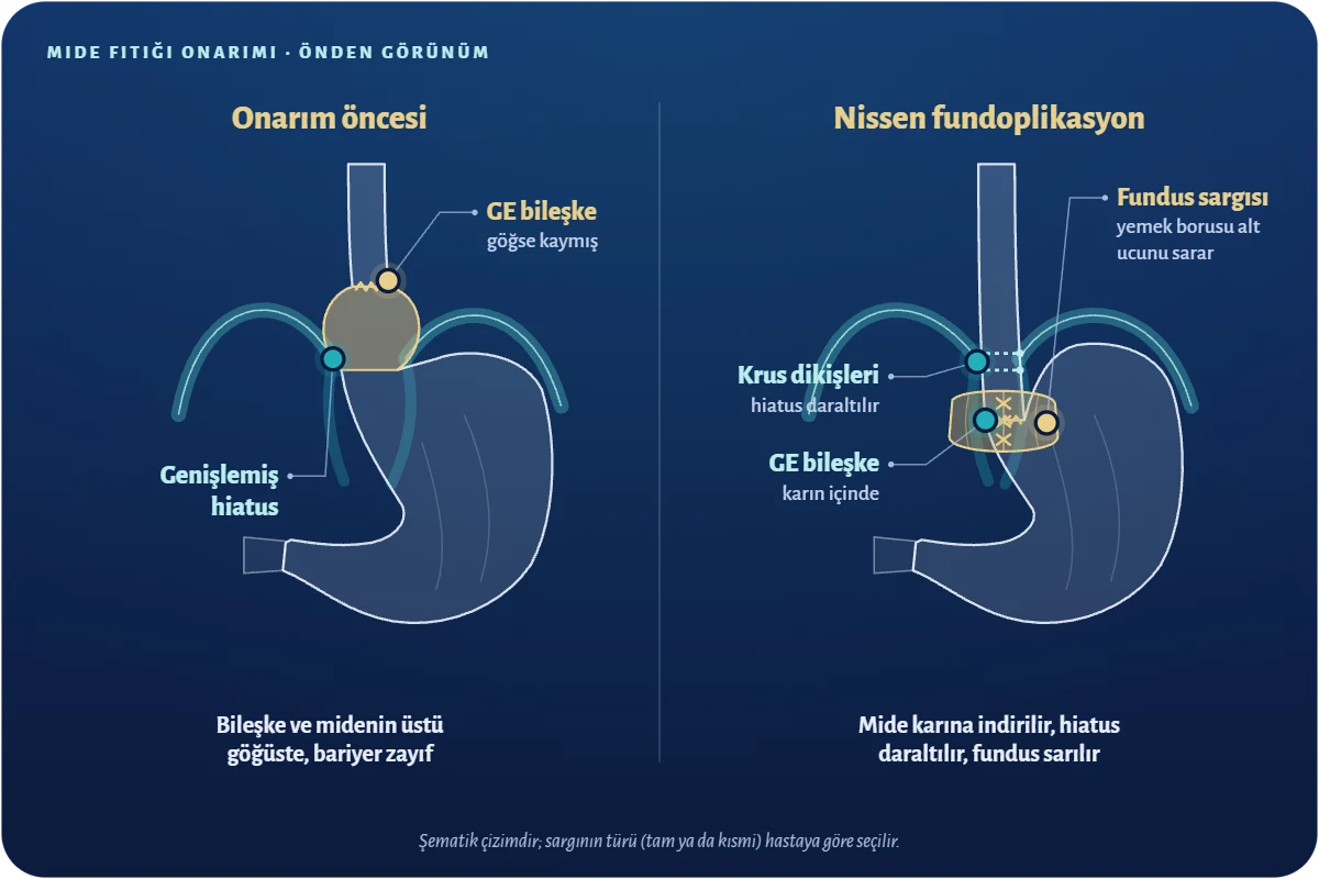 Mide fıtığı ameliyatı Nissen fundoplikasyon