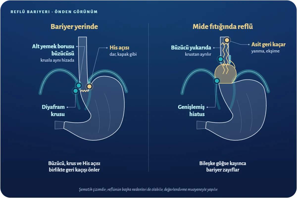 Mide fıtığı reflü ilişkisi nasıl