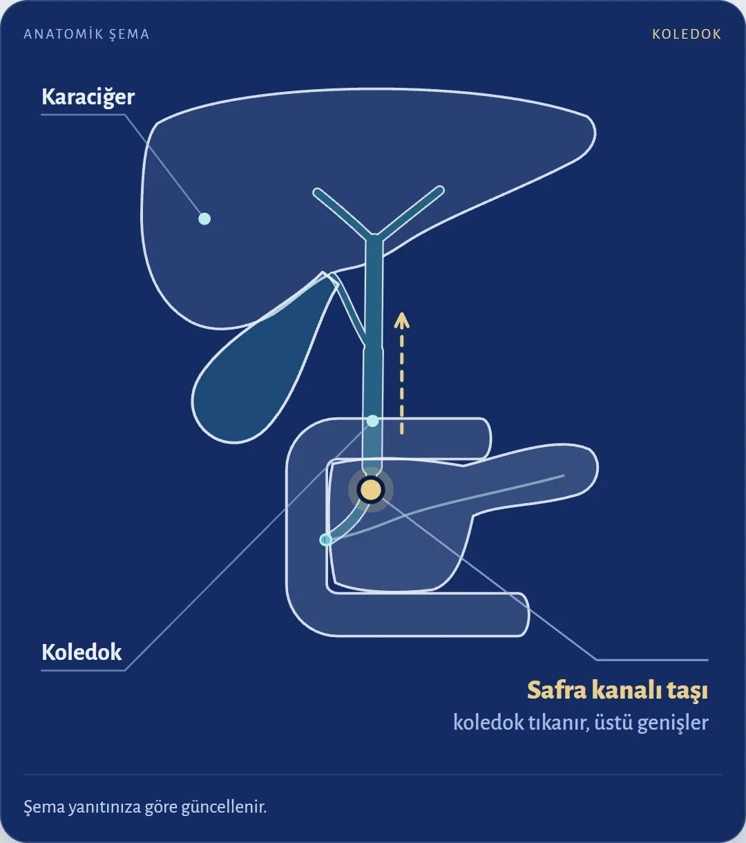 Safra kanalında taş nerede durur